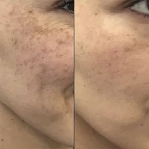 Dermapen Microneedling - 4