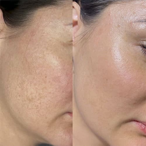 Dermapen Microneedling - 5