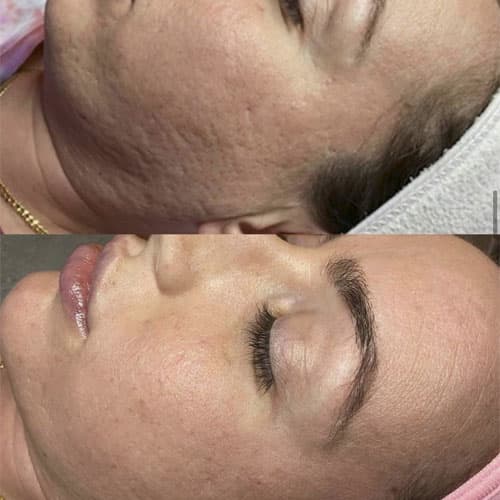 Dermapen Microneedling - 1