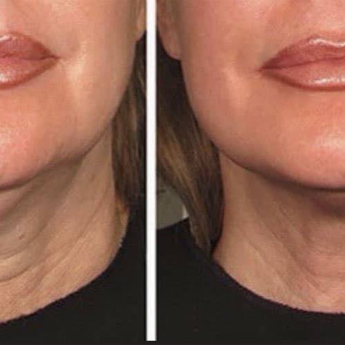 Dermapen Microneedling - 2