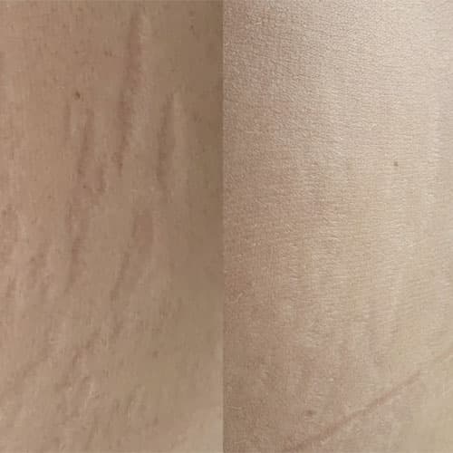 Dermapen Microneedling - 3