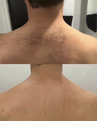 Epilare Definitivă Laser - 1