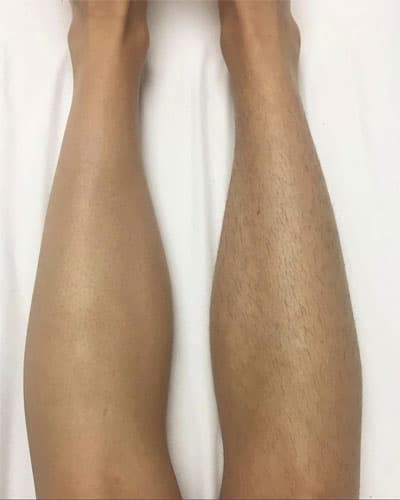 Epilare Definitivă Laser - 4