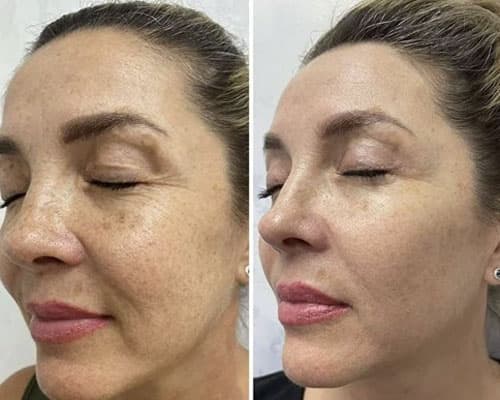 Radiofrecvență - 5