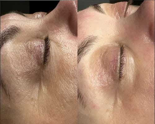 Radiofrecvență - 1