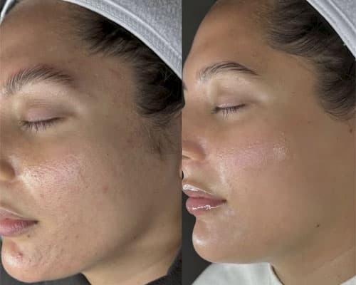 Radiofrecvență - 3