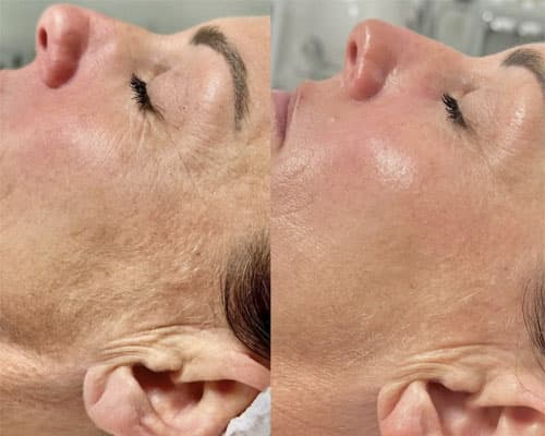 Radiofrecvență - 4