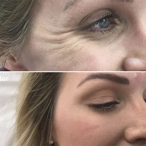 Rejuvenare Facială București - 2