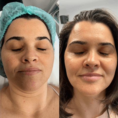 Rejuvenare Facială București - 3