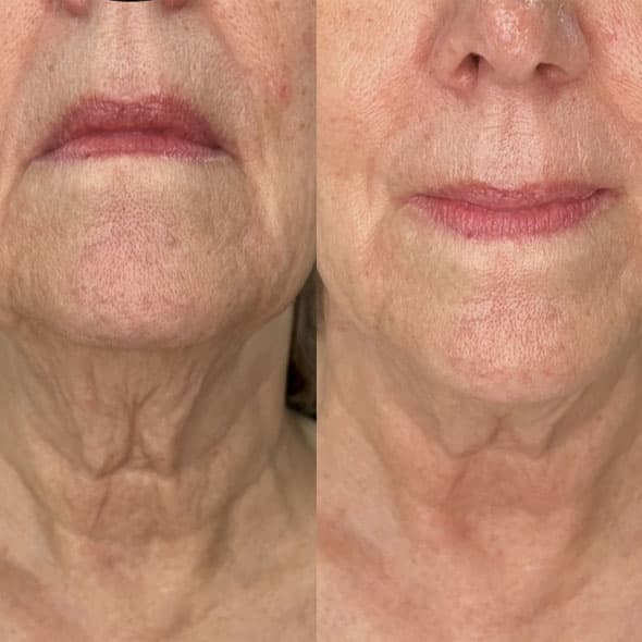 Rejuvenare Facială București - 4