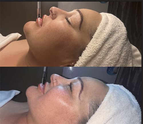 Terapie cu Oxigen Hiperbaric - 5