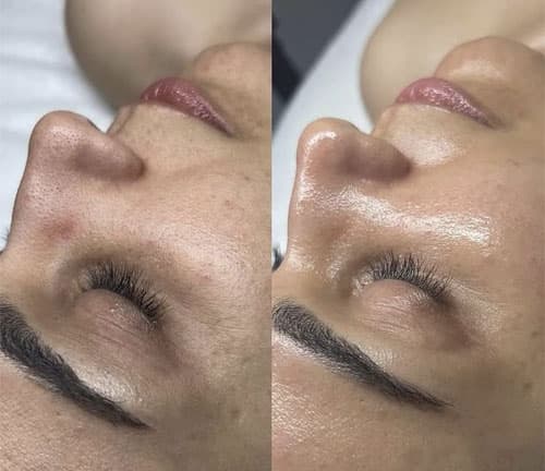 Terapie cu Oxigen Hiperbaric - 6