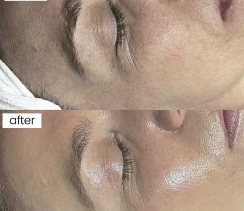 Terapie cu Oxigen Hiperbaric - 1