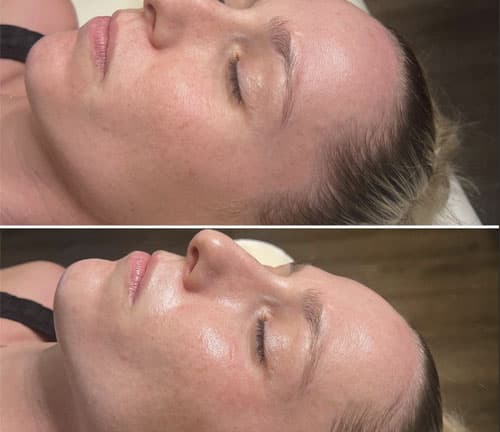 Terapie cu Oxigen Hiperbaric - 2