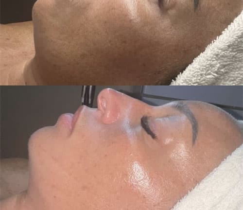 Terapie cu Oxigen Hiperbaric - 3