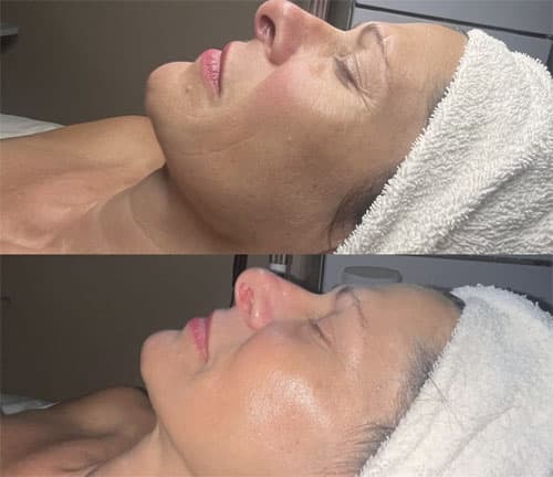 Terapie cu Oxigen Hiperbaric - 4