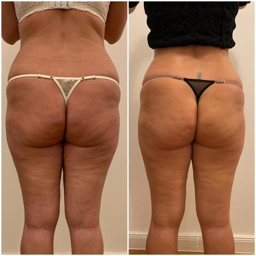 Zionic Treatment - 1