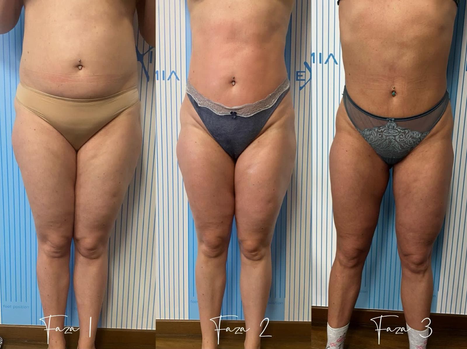 Tratament Eximia Bucuresti - 17