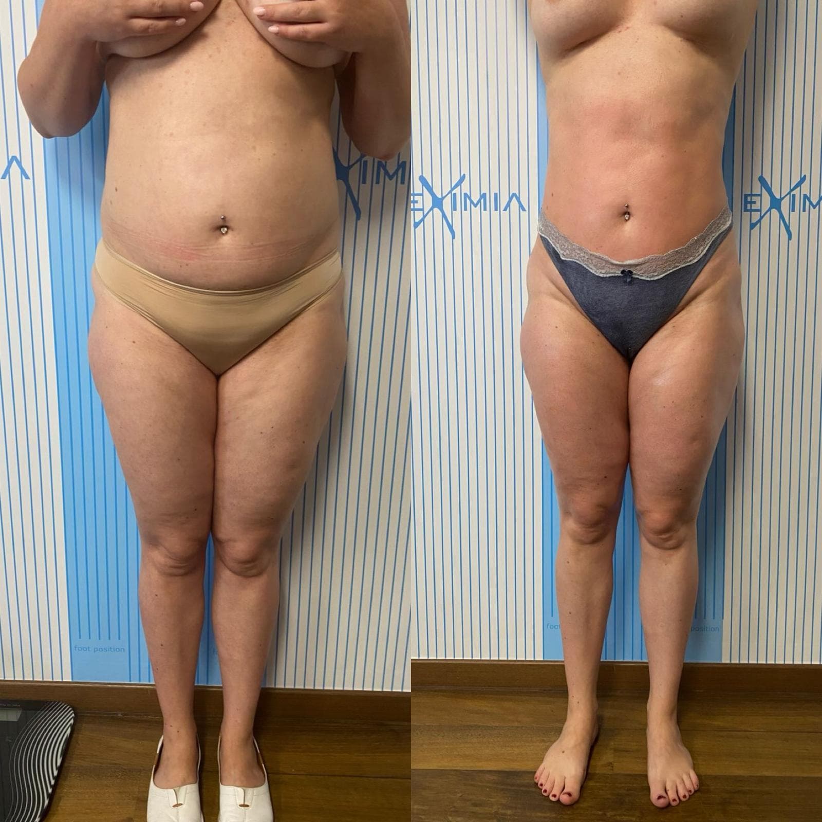 Tratament Eximia Bucuresti - 1