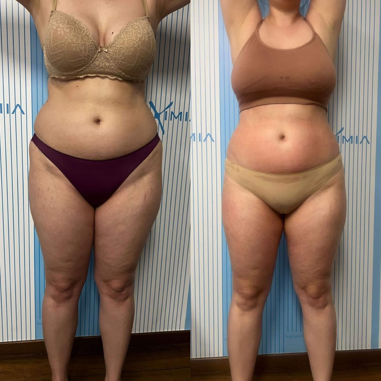 Tratament Eximia Bucuresti - 4