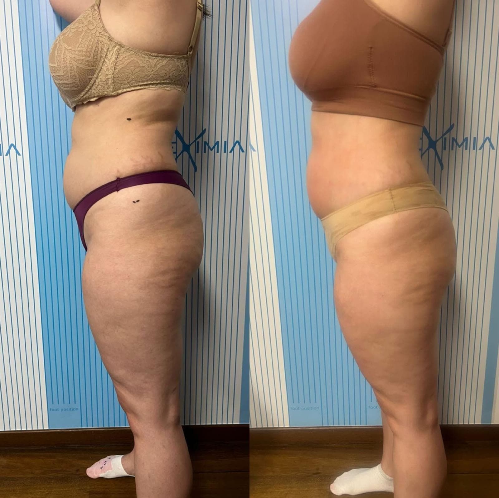 Tratament Eximia Bucuresti - 6