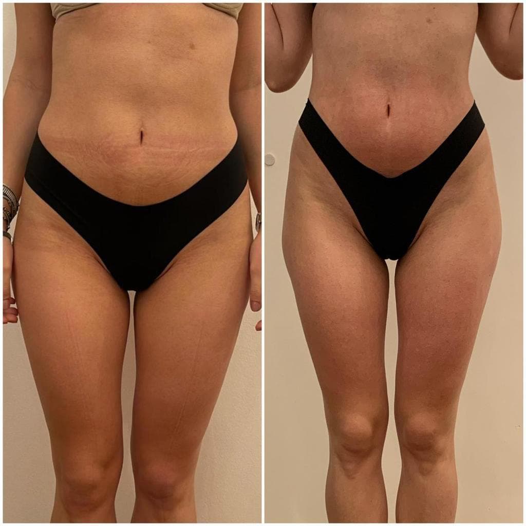 Zionic Treatment - 3