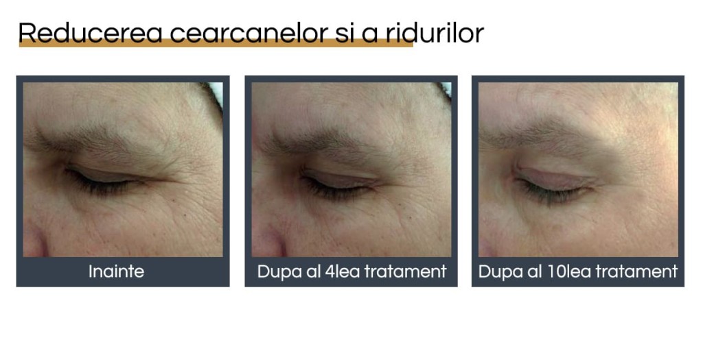 Rejuvenare facială București 16 rejuvenare faciala before and after