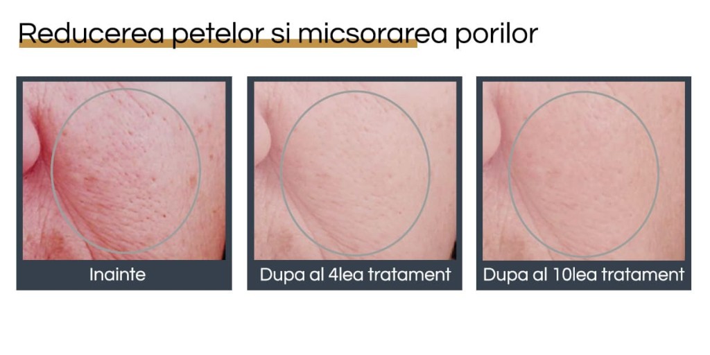 Rejuvenare facială București 15 rejuvenare faciala before and after