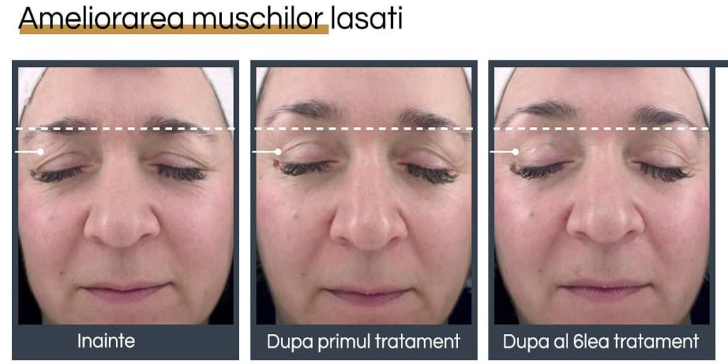 Rejuvenare facială București 14 rejuvenare faciala before and after