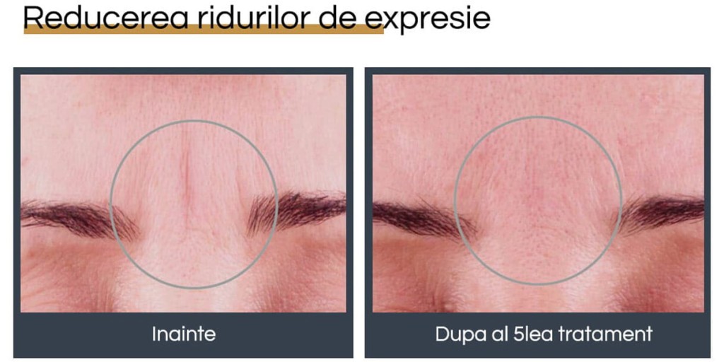 Rejuvenare facială București 13 rejuvenare faciala before and after