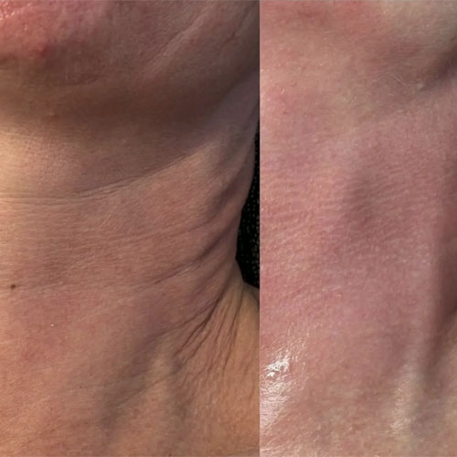 Dermapen 19 dermapen