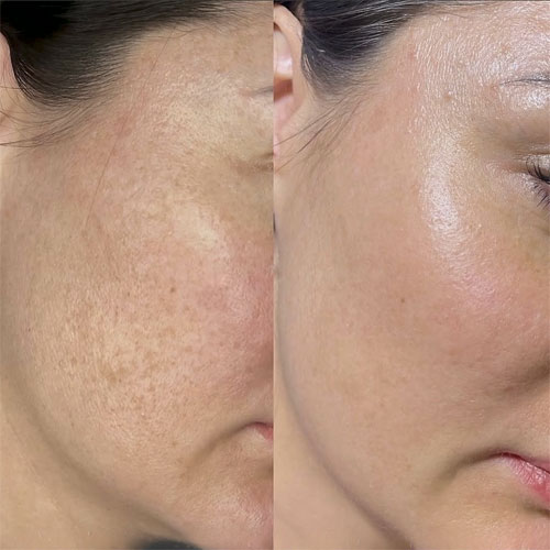 Dermapen 21 dermapen2