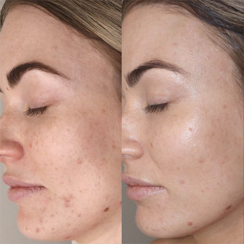 Dermapen 22 dermapen3