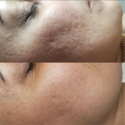 Dermapen 23 dermapen4