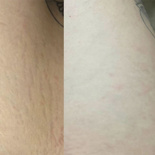 Dermapen 24 dermapen5
