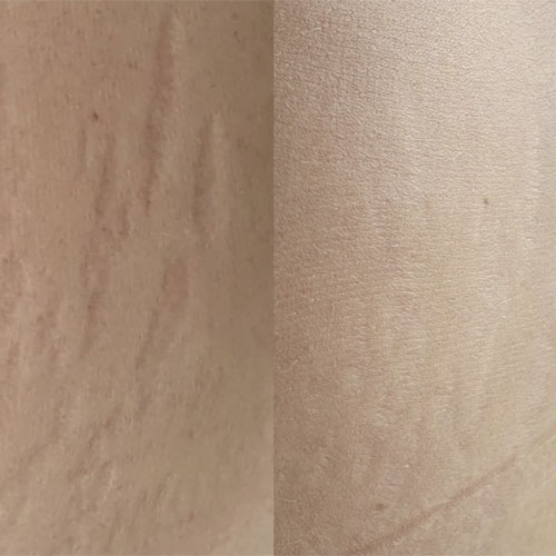 Dermapen 27 dermapen8