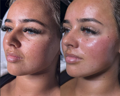 Mezoterapie facială 8 mezoterapie faciala