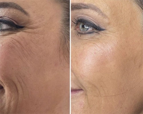 Mezoterapie facială 9 mezoterapie faciala1