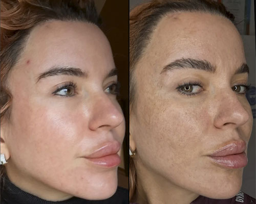 Mezoterapie facială 10 mezoterapie faciala2
