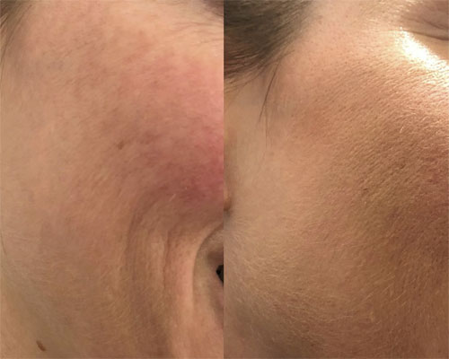 Mezoterapie facială 11 mezoterapie faciala3