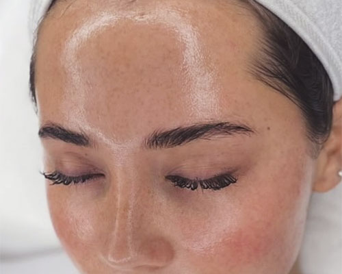 Mezoterapie facială 12 mezoterapie faciala4