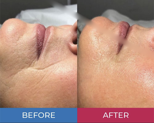 Mezoterapie facială 13 mezoterapie faciala5