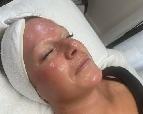 Mezoterapie facială 14 mezoterapie faciala6