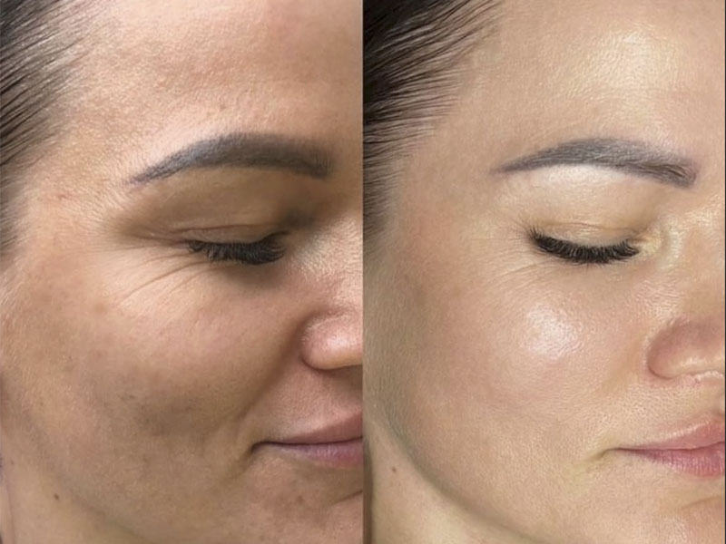 Microdermabraziune 7 microdermabraziune1