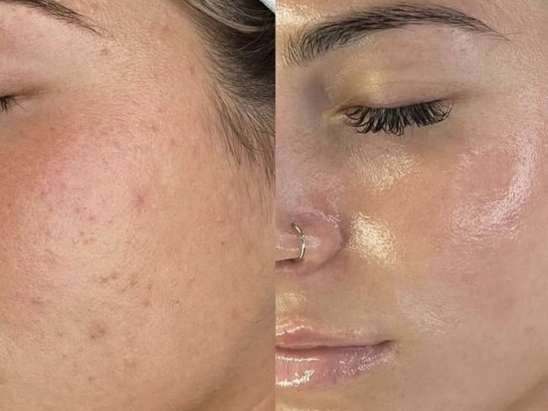 Microdermabraziune 8 microdermabraziune2