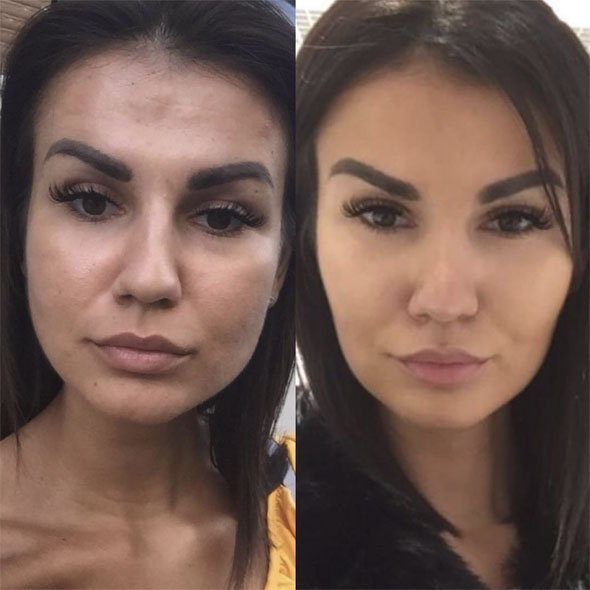 Rejuvenare facială București 19 rejuvenare faciala1