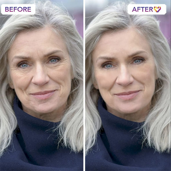 Rejuvenare facială București 21 rejuvenare faciala3