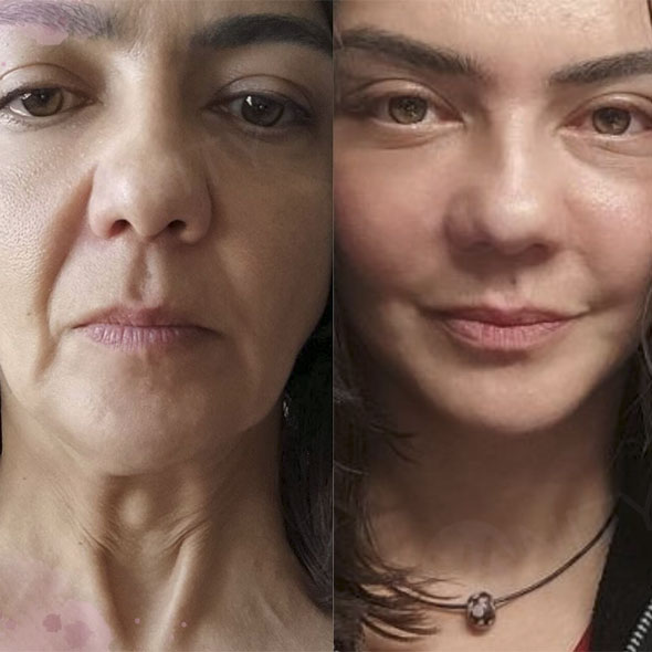 Rejuvenare facială București 22 rejuvenare faciala4