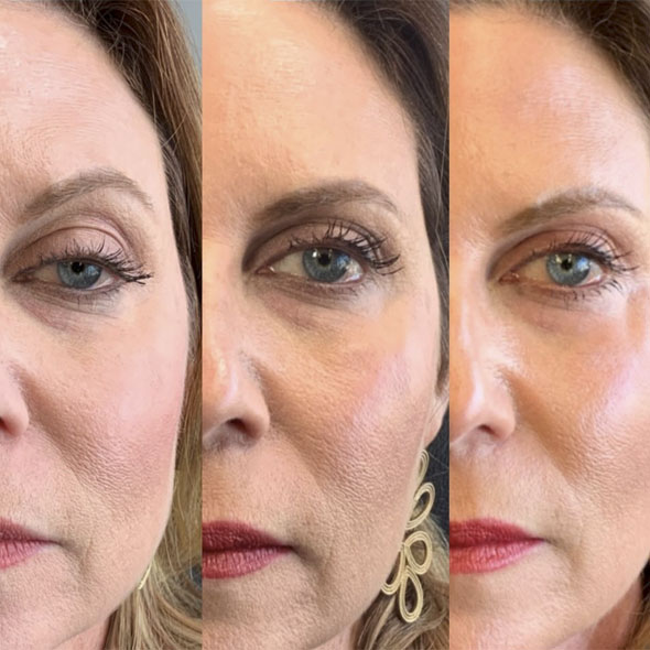 Rejuvenare facială București 23 rejuvenare faciala5