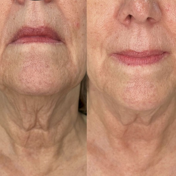 Rejuvenare facială București 24 rejuvenare faciala6